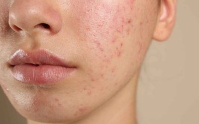 Masna koža i akne: Kako postići blistavu kožu prema savjetima farmaceuta i dermatologa